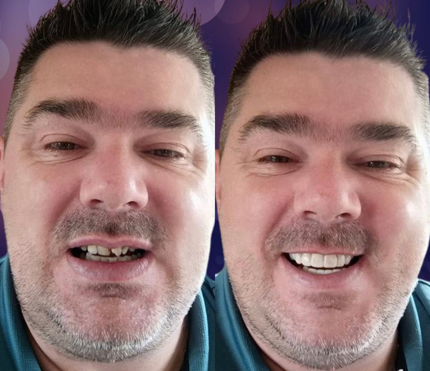 Snap On Smile (SI) 6