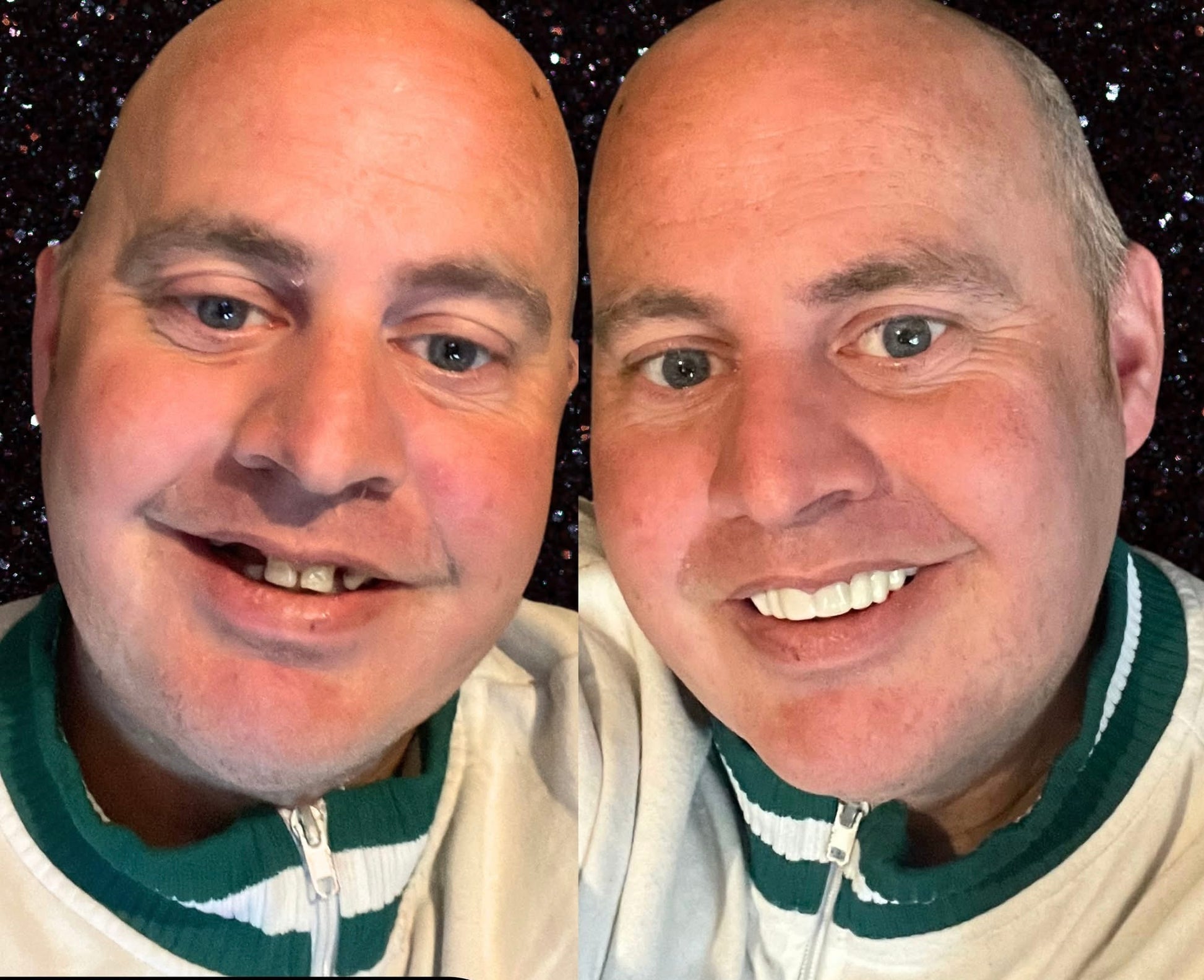 Snap On Smile (BG) 8