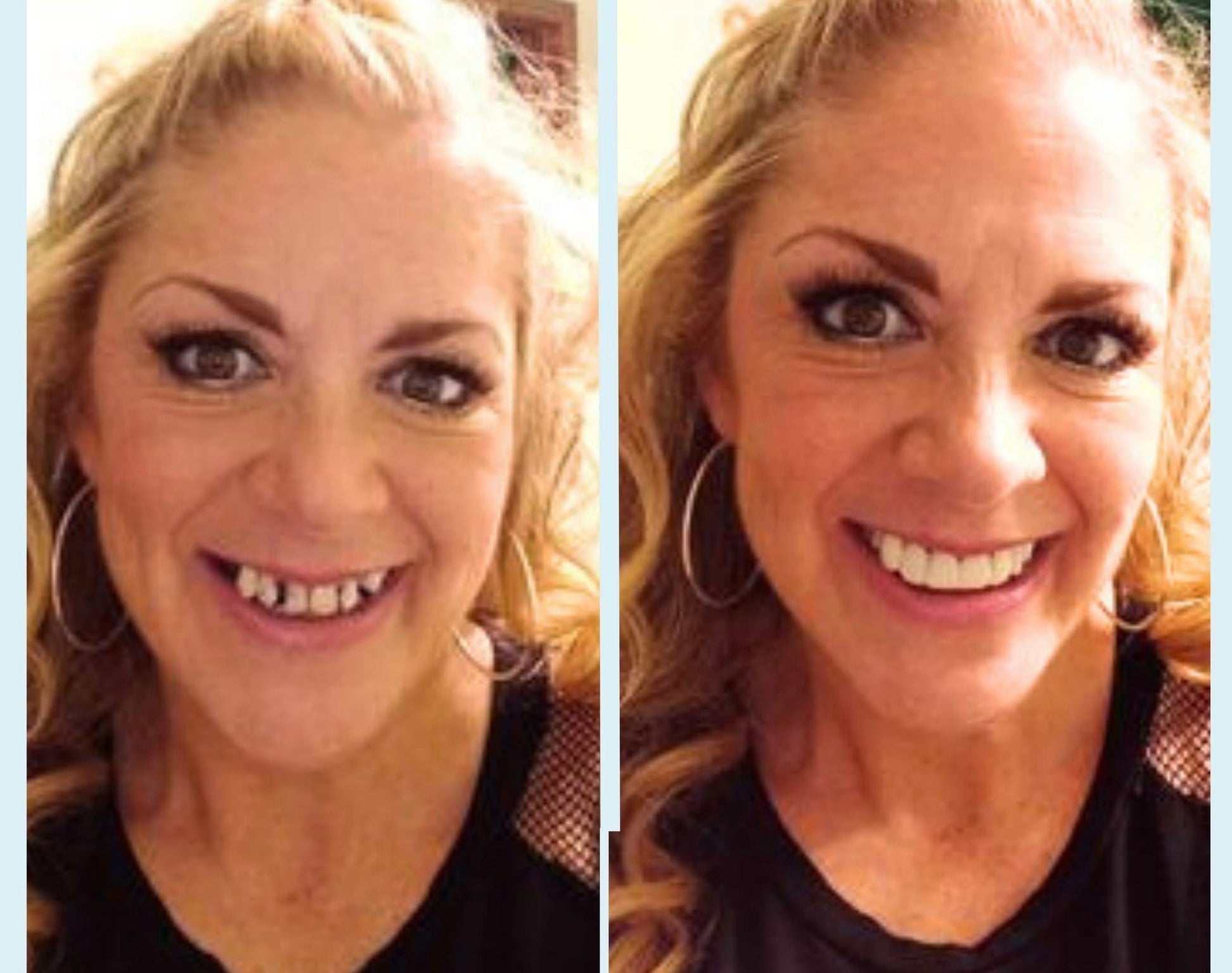 Snap On Smile (GR) 2