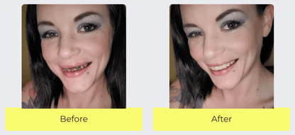 Snap On Smile (RO) 2